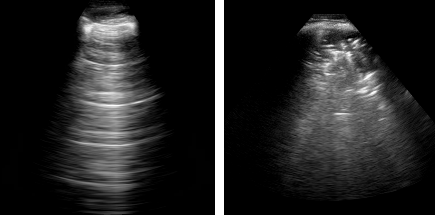 Two fan-shaped grayscale lung ultrasound images side by side: the left shows repeating bright horizontal lines, the right a grainy, speckled texture.